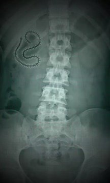 X射线扫描器胃0