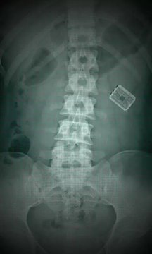 X射线扫描器胃2